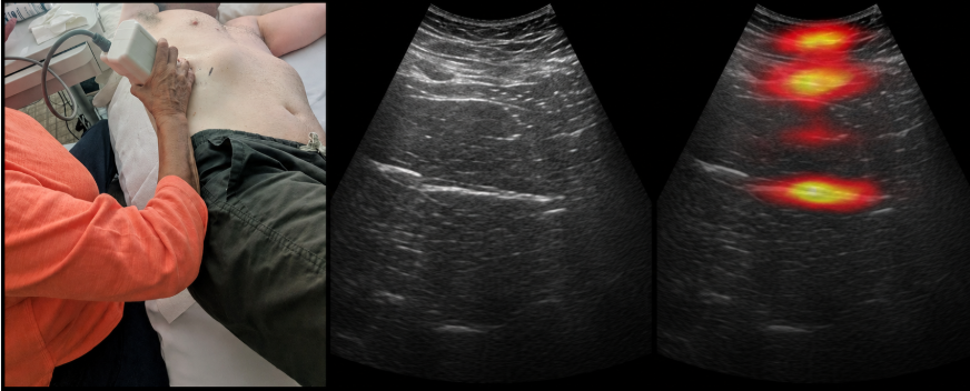 TAEUS clinical workflow for liver fat assessment